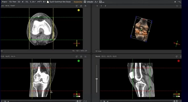 Implant Planning Controls